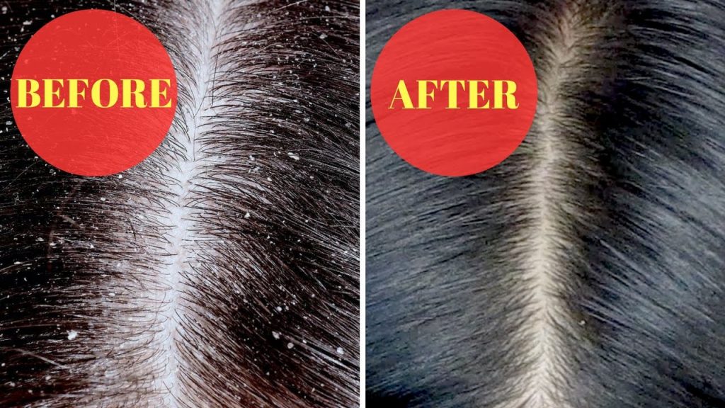 Science proves Use lemon juice to get rid of dandruff. Dubai Standard